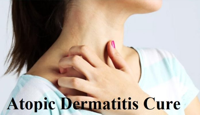 Atopic Dermatitis Cure