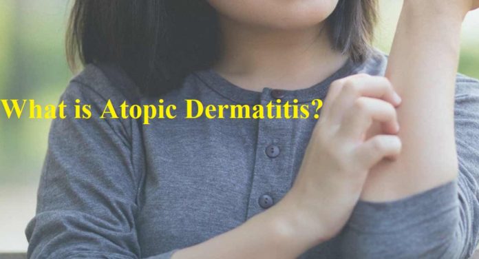 What is Atopic Dermatitis?