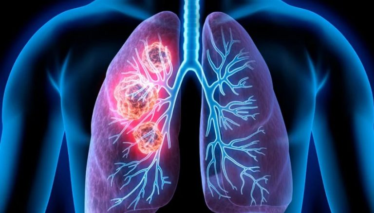 lung cancer