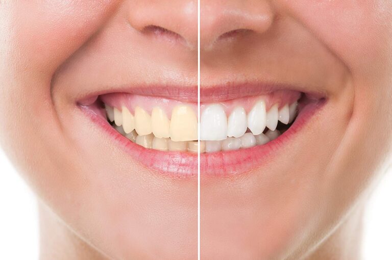 Stained Or Discoloured Teeth