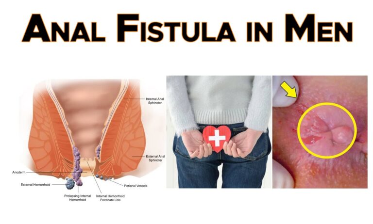 5 Common Reasons for Anal Fistula in Men