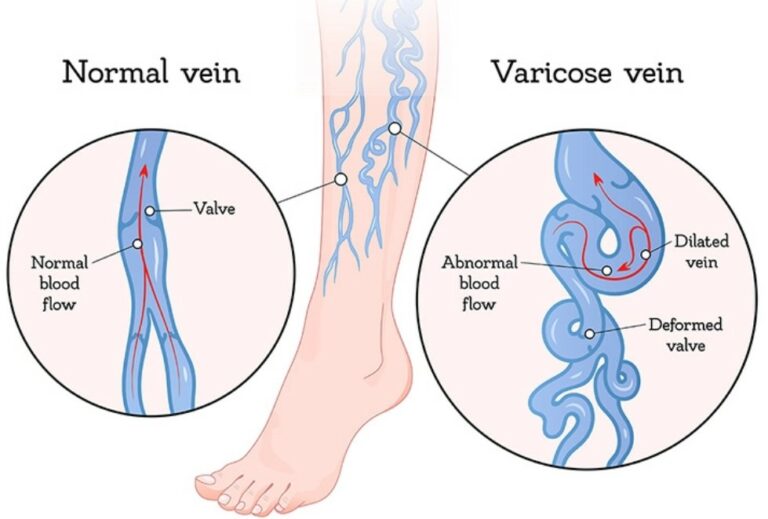 Varicose Veins