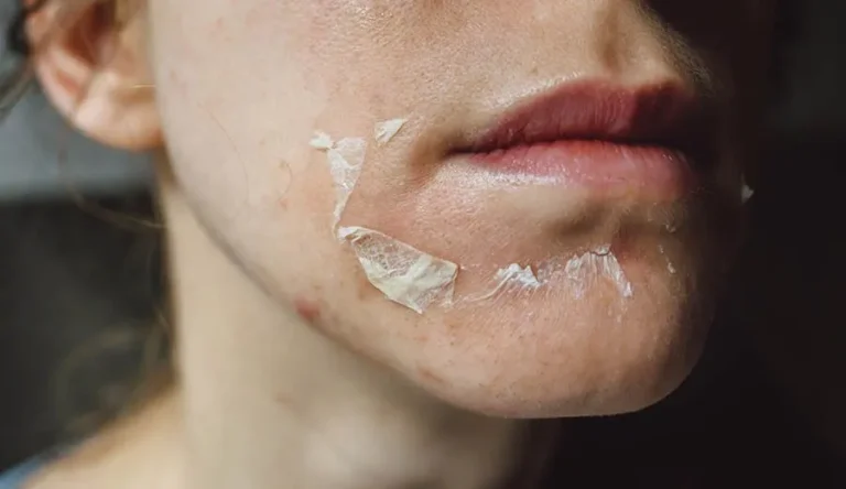 Chemical Peel Aftercare